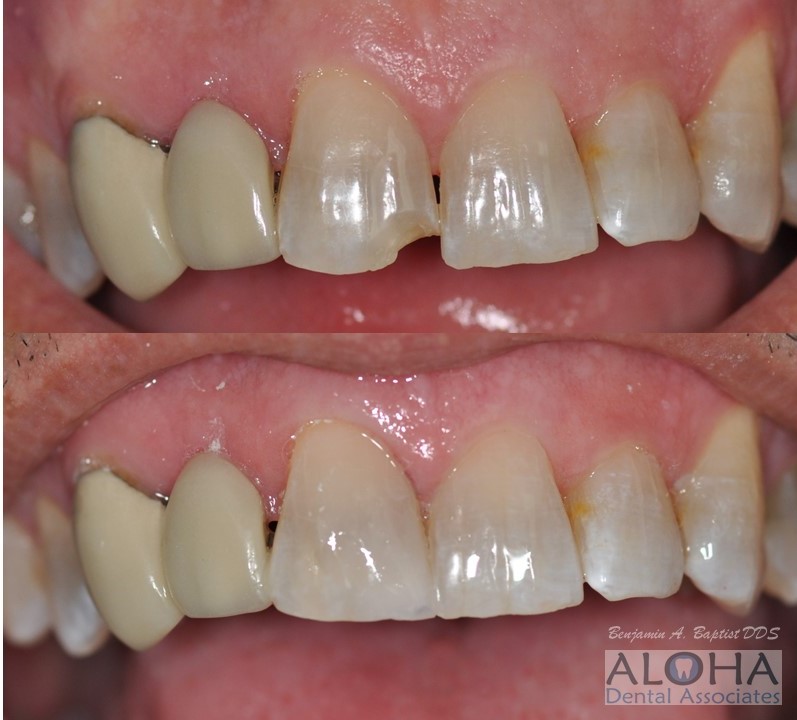 Before and After Dental Bonding at Aloha Dental Associates