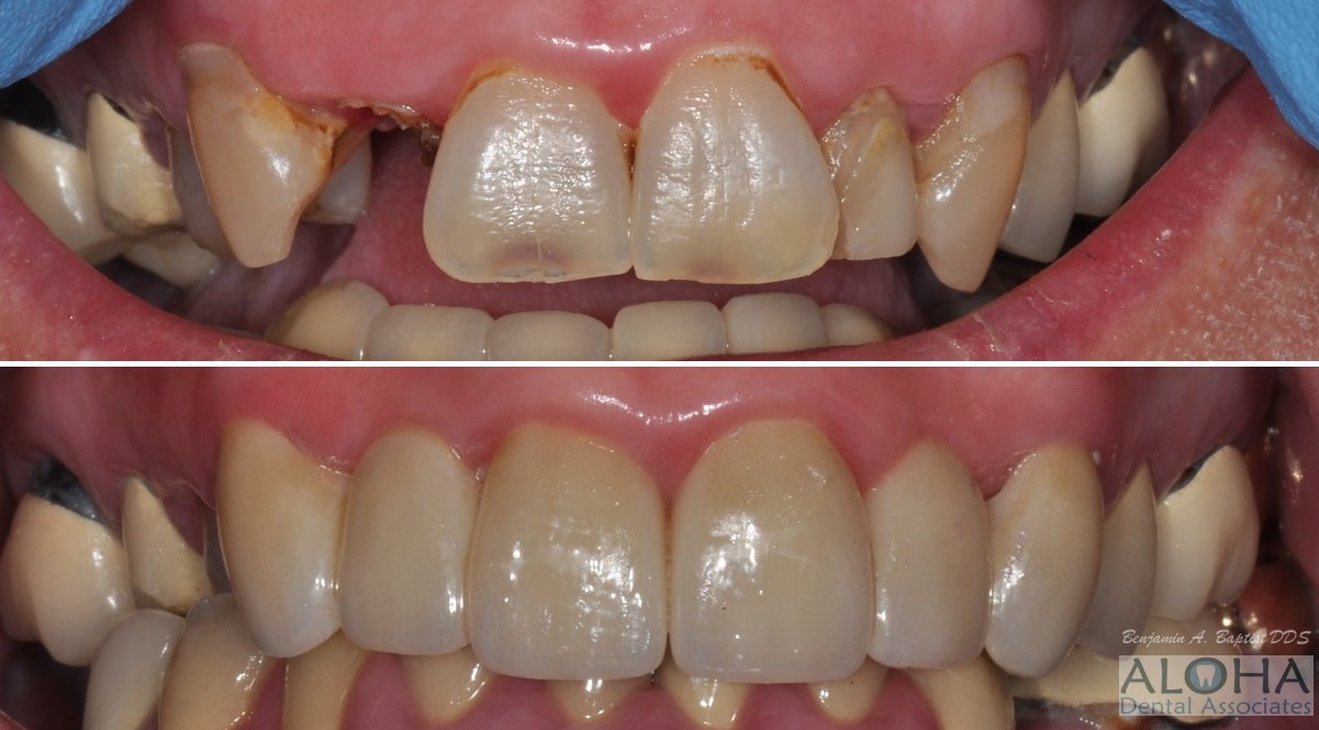 Before and After Dental Bridge at Aloha Dental Associates