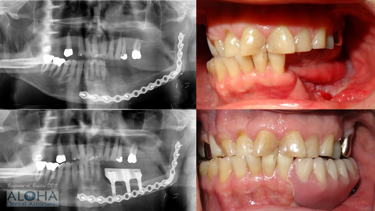 Before and After Dental Implants at Aloha Dental Associates