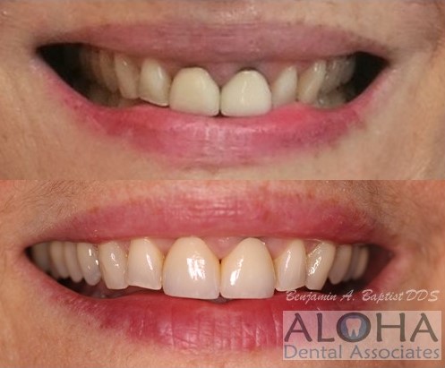 Before and After Dental Crowns at Aloha Dental Associates
