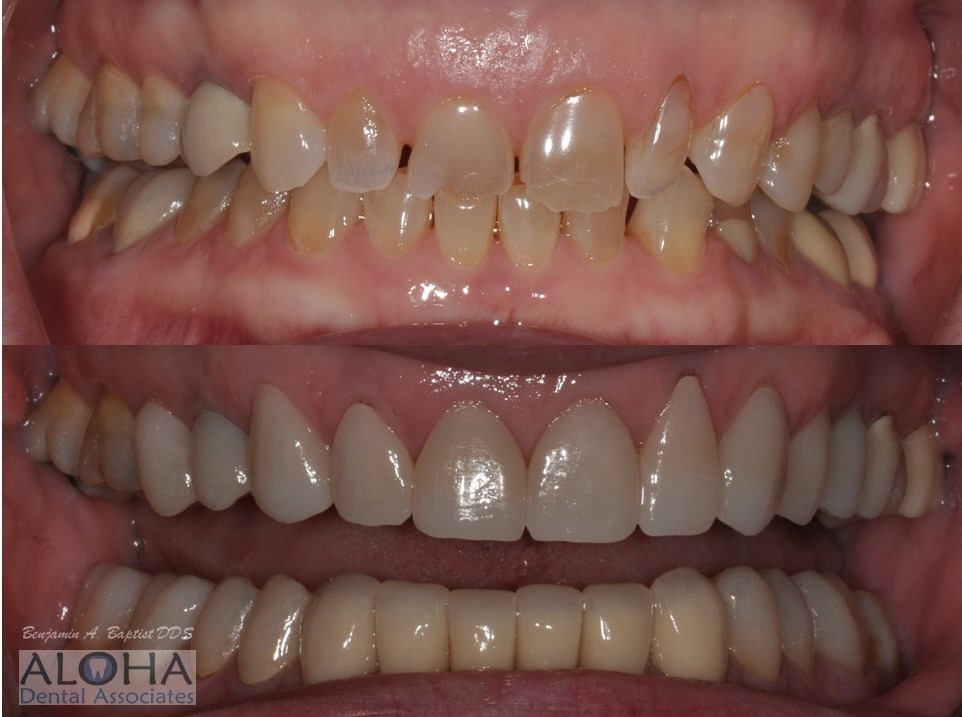 Before and After Dental Crowns at Aloha Dental Associates