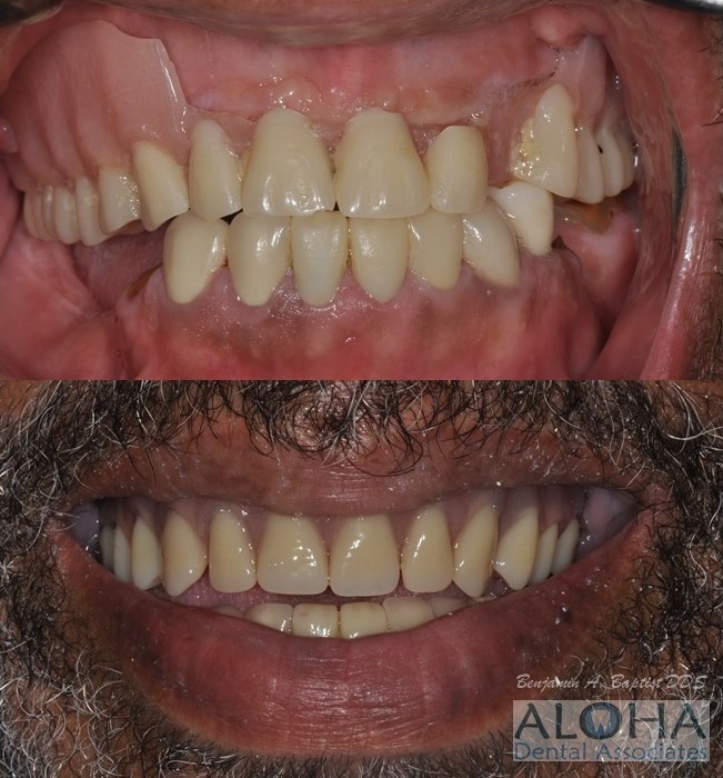 Before and After Dentures at Aloha Dental Associates
