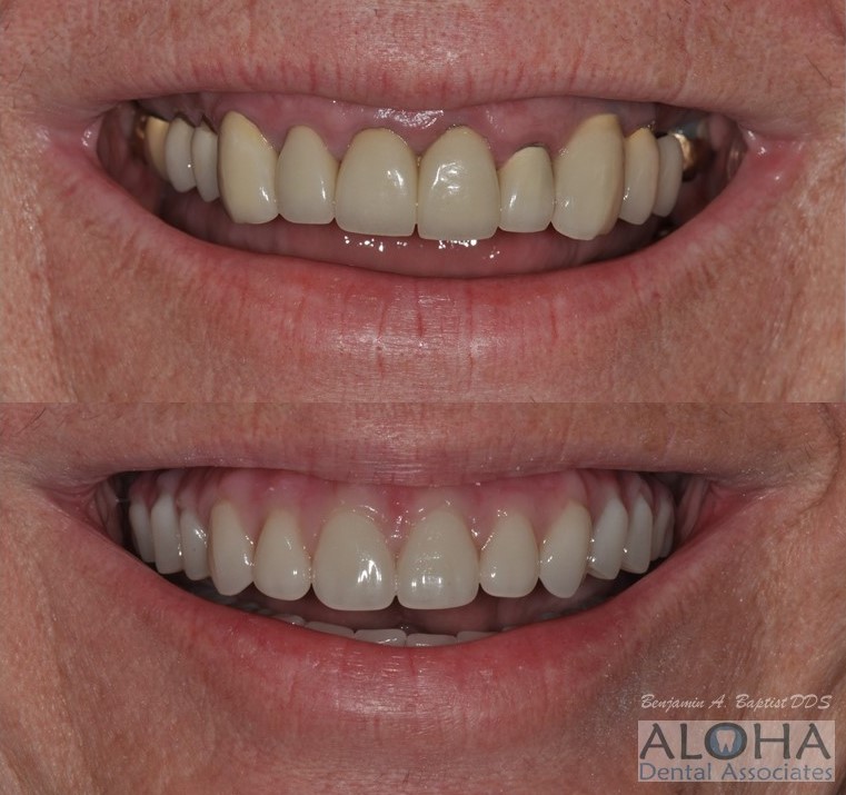 Before and After Dental Implants at Aloha Dental Associates