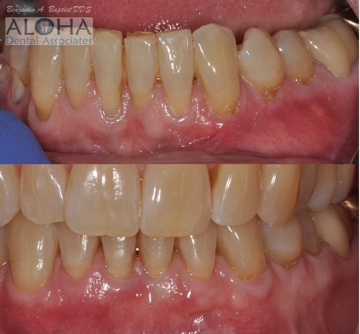 Before and After Gum Grafting at Aloha Dental Associates