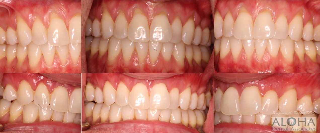 Before and After Gum Grafting at Aloha Dental Associates